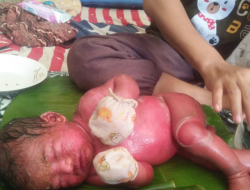 Bayi Lahir Kondisi Kulit Mengering dan Memerah di Desa Baru Dirujuk ke RS Umum Bangkinang