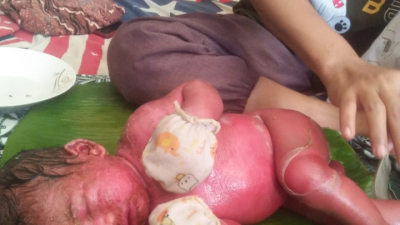 Bayi Lahir Kondisi Kulit Mengering dan Memerah di Desa Baru Dirujuk ke RS Umum Bangkinang